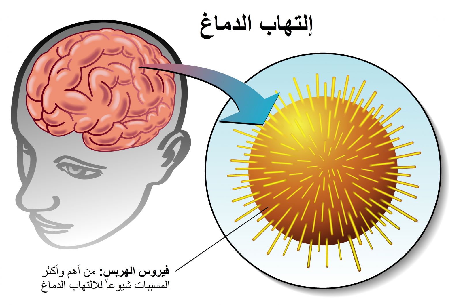 فيروس الهربس من اكثر المسببات شيوعاً لمرض التهاب الدماغ
