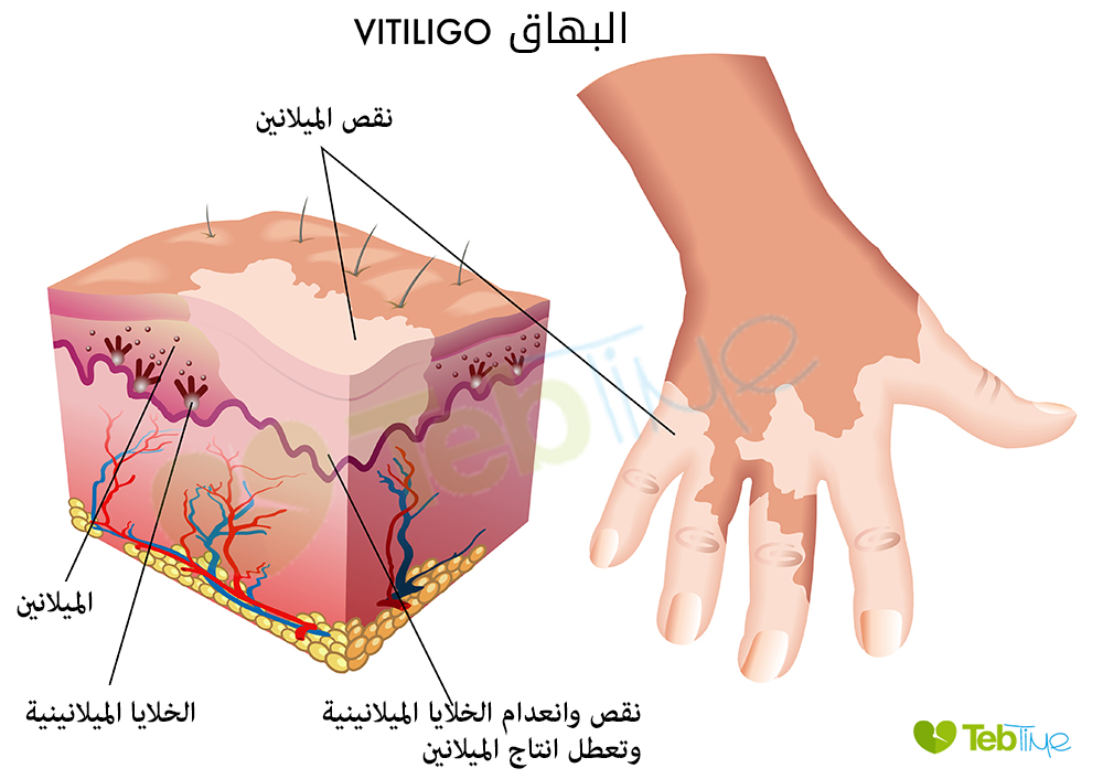 مرض البهاق Vitiligo: خلل في انتاج الميلانين